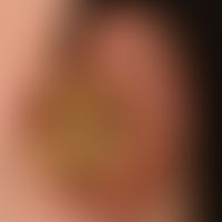 Cornu cutaneum: Cornu cutaneum that has existed for years, is broadly seated and has been in pain...