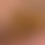 Cornu cutaneum: Cornu cutaneum that has been in existence for many years, broadly seated, and has...