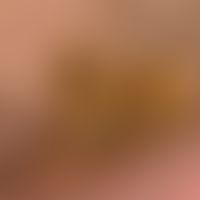 Cornu cutaneum: Cornu cutaneum that has been in existence for many years, broadly seated, and has...