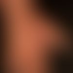Granuloma anulare disseminatum: non-painful, non-itching, disseminated, large-area plaques that a...