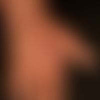 Granuloma anulare disseminatum: non-painful, non-itching, disseminated, large-area plaques that a...