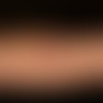 Granuloma anulare disseminatum: non-painful, non-itching, disseminated, large-area, anular (only ...