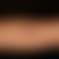 Granuloma anulare disseminatum: non-painful, non-itching, disseminated, large-area, anular (only ...