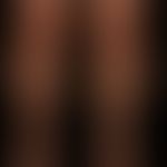 Granuloma anulare disseminatum: non-painful, non-itching, disseminated, large-area plaques that a...