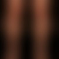 Granuloma anulare disseminatum: non-painful, non-itching, disseminated, large-area plaques that a...