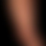 Granuloma anulare disseminatum: non-painful, non-itching, disseminated, large-area plaques that a...