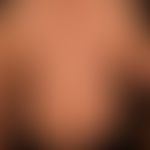 Granuloma anulare disseminatum: non-painful, non-itching, disseminated, large-area plaques that a...