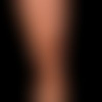 Granuloma anulare disseminatum: non-painful, non-itching, disseminated, large-area plaques that a...