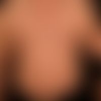Granuloma anulare disseminatum: generalisierte, großflächige, braune, kaum erhabene Plaques mit a...