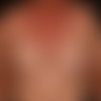Drug exanthema after ingestion of a cephalosporin. 4 days after continuous intake of the antibiot...