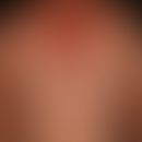 drug exanthema after ingestion of a cephalosporin. 4 days after continuous intake of the antibiot...