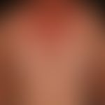 drug exanthema after ingestion of a cephalosporin. 4 days after continuous intake of the antibiot...