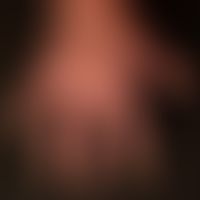 Erythrodermie: schwere Onychodystrophie (Onychgrypose) bei mehrjährig bestehender Erythrodermie b...