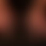 Onychogrypose: 10-Nagel-Onychogrypose bei mehrjährig bestehender Erythrodermie ungeklärter Ätiolo...