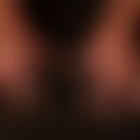 Onychogrypose: 10-Nagel-Onychogrypose bei mehrjährig bestehender Erythrodermie ungeklärter Ätiolo...