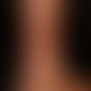 Purpura thrombozytopenische: buntes Bild einer orthostatischen Purpura mit frischen, punktförmige...