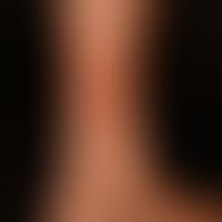 Purpura thrombozytopenische: buntes Bild einer orthostatischen Purpura mit frischen, punktförmige...