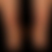 Purpura thrombozytopenische: buntes Bild einer, symmetrischen, orthostatischen Purpura mit frisch...