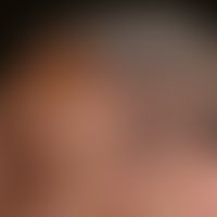 Elastoidosis cutanea nodularis et cystica: multiple, chronic inpatient, 0.2-0.4 cm large, symptom...