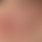 Melanom: diffuse, kutane Metastasierung (amelanotische Metasen) im Bereich der Thoraxwand. Primär...