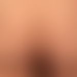 Mycosis fungoides tumor stage: mycosis fungoides has been known for several years. for several mo...