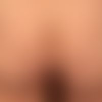 Mycosis fungoides tumor stage: mycosis fungoides has been known for several years. for several mo...