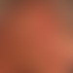 Mycosis fungoides tumor stage: Mycosis fungoides has been known for many years; continuous occurr...