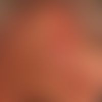 Mycosis fungoides Tumor-Stadium:&nbsp;seit Jahren bekannte Mycosis fungoides.Seit Monaten kontinu...