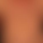 Mycosis fungoides plaque stage: mycosis fungoides has been known for years. for several months co...