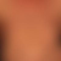 Mycosis fungoides plaque stage: mycosis fungoides has been known for years. for several months co...