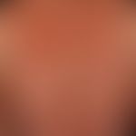 Mycosis fungoides tumor stage: Mycosis fungoides has been known for many years, and for several m...