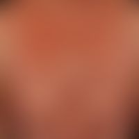 Mycosis fungoides tumor stage: Mycosis fungoides has been known for many years, and for several m...