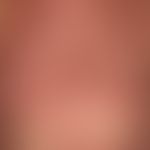 mycosis fungoides tumor stage: mycosis fungoides known for years. since a few months rapid appear...