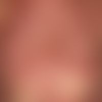 Mycosis fungoides Tumor-Stadium: seit Jahren bekannte Mycosis fungoides. Seit wenigen Monaten ras...