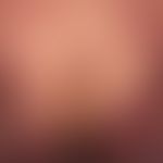 Mycosis fungoides advanced tumor stage: since years known Mycosis fungoides. advanced tumor stage...