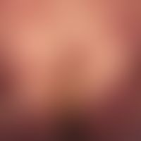 Mycosis fungoides fortgeschrittenes Tumor-Stadium: seit Jahren bekannte Mycosis fungoides. Fortge...
