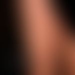 Acrodermatitis chronica atrophicans. general view: blurred, livid red, spots on the right thigh. ...