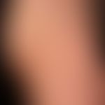 Acrodermatitis chronica atrophicans. general view: blurred, livid red, spots on the right thigh e...