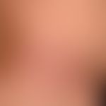 acrodermatitis chronica atrophicans: blurred, livid red, (scaleless) symptomless spots. right upp...