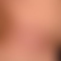 Acrodermatitis chronica atrophicans: unscharf begrenzte, lividrote, (schuppenlose) symptomlose Fl...