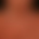 Mycosis fungoides tumor stage: poicilodermatous tumor stage with extensive erythema, plaques and ...