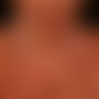 Mycosis fungoides tumor stage: poicilodermatous tumor stage with extensive erythema, plaques and ...