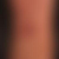 Mycosis fungoides tumor stage: Mycosis fungoides has been known for years and has been present fo...