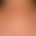 Teleangiectasia macularis eruptiva perstans. 58-jähriger Patient mit seit Jahren bestehenden&nbsp...