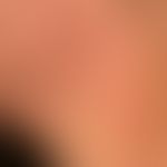 Teleangiectasia macularis eruptiva perstans. 58-jähriger Patient mit einem seit Jahren bestehende...
