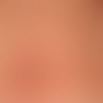 Teleangiectasia macularis eruptiva perstans. 58-jähriger Patient mit seit Jahren bestehendem gene...
