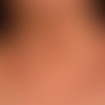 Airborne Contact dermatitis:&nbsp;chronisches (>6 Wochen) flächenhaftes, sehr stark juckendes ...