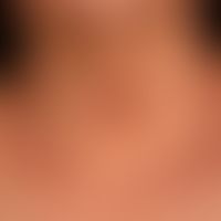 Airborne Contact dermatitis:&nbsp;chronisches (>6 Wochen) flächenhaftes, sehr stark juckendes ...