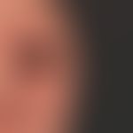 Airborne Contact Dermatitis: Befund 2 Jahren später. Zwischenzeitliche Abheilung. Akute flächenha...