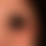 Airborne Contact Dermatitis: chronisches (>6 Wochen) flächenhaftes, enorm juckendes und brenne...
